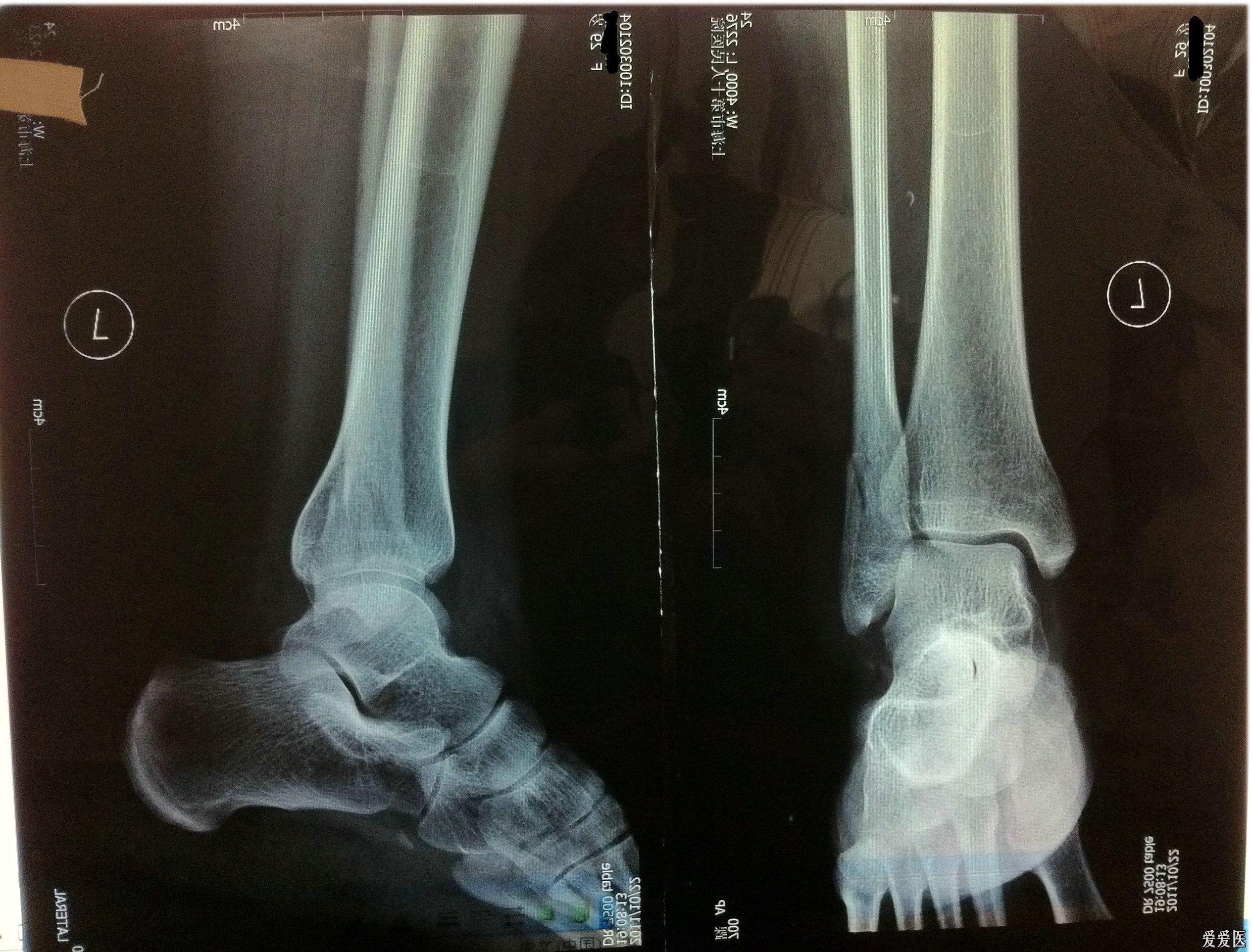 左脚腓骨骨折图片图片