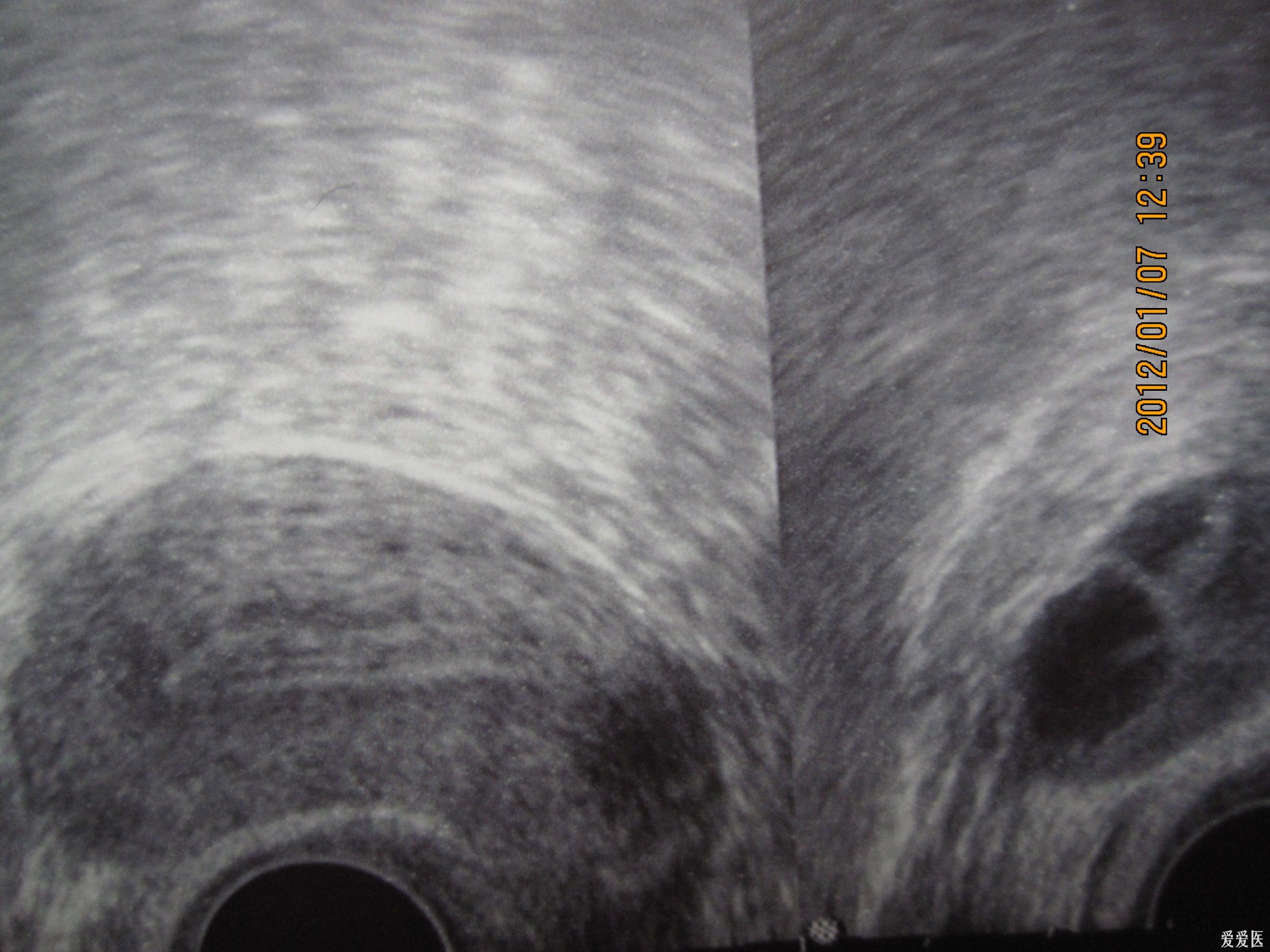 请问这个b超能排除宫腔粘连么