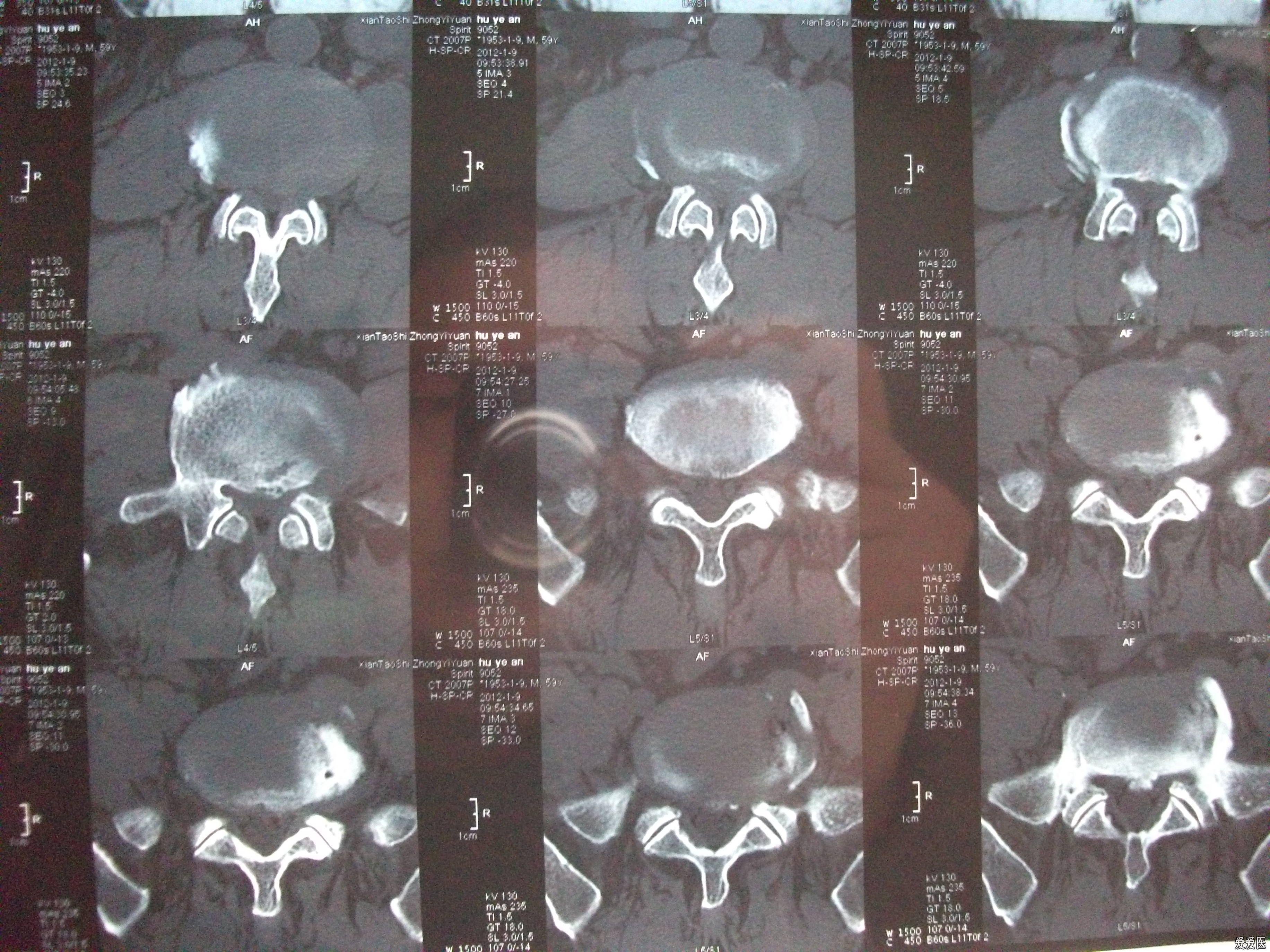 腰椎間盤突出病人的ct片
