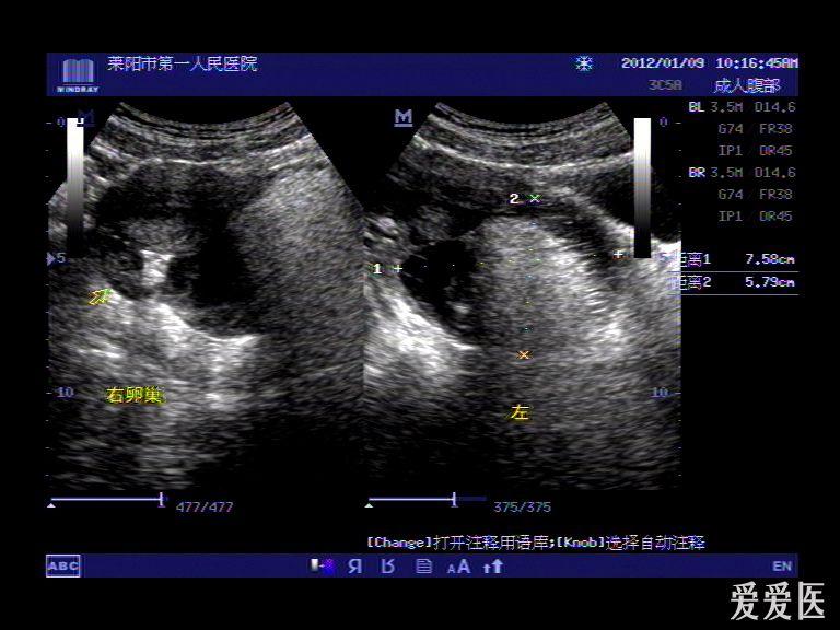 左侧附件区畸胎瘤(随访中 超声医学讨论版 爱爱医医学论坛