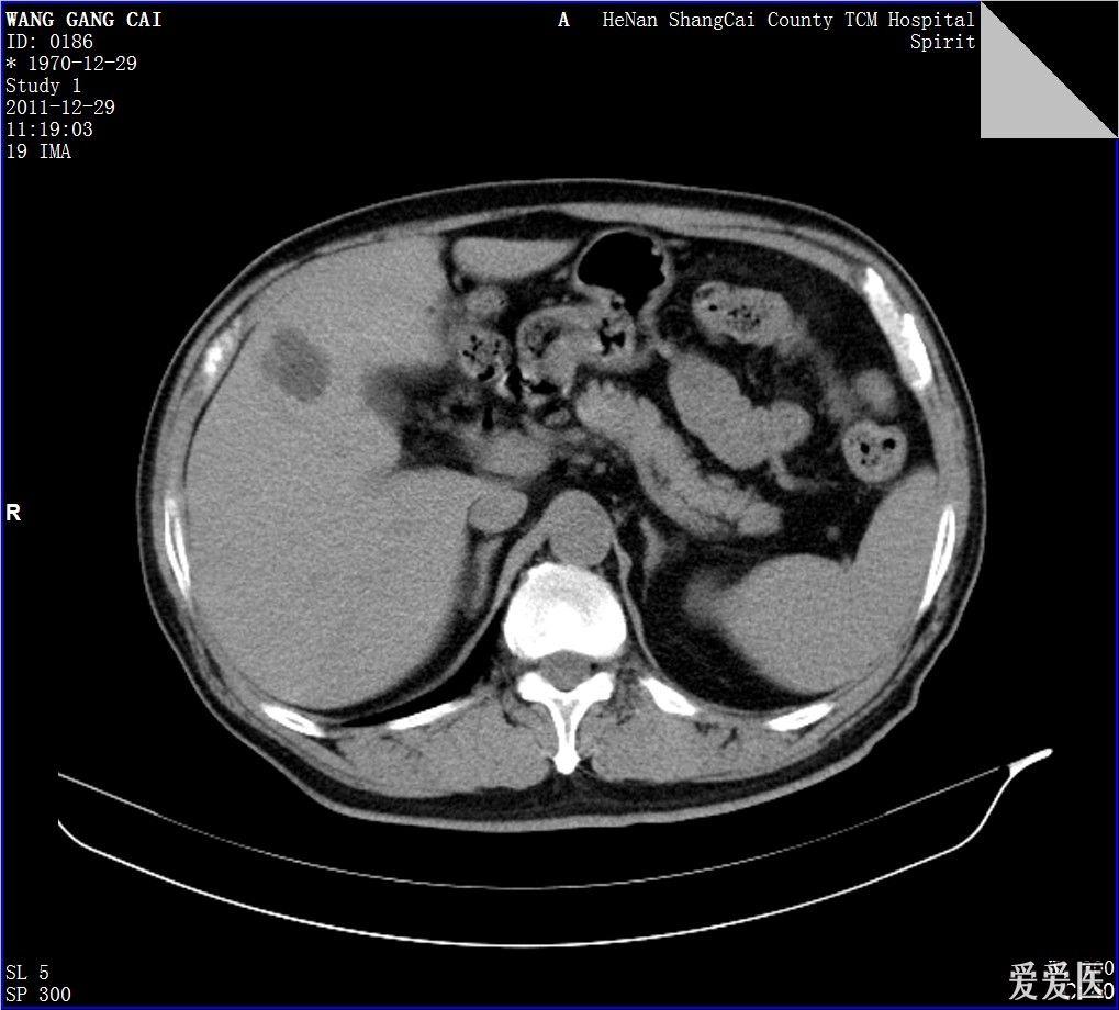 正常肝脏核磁共振图片图片
