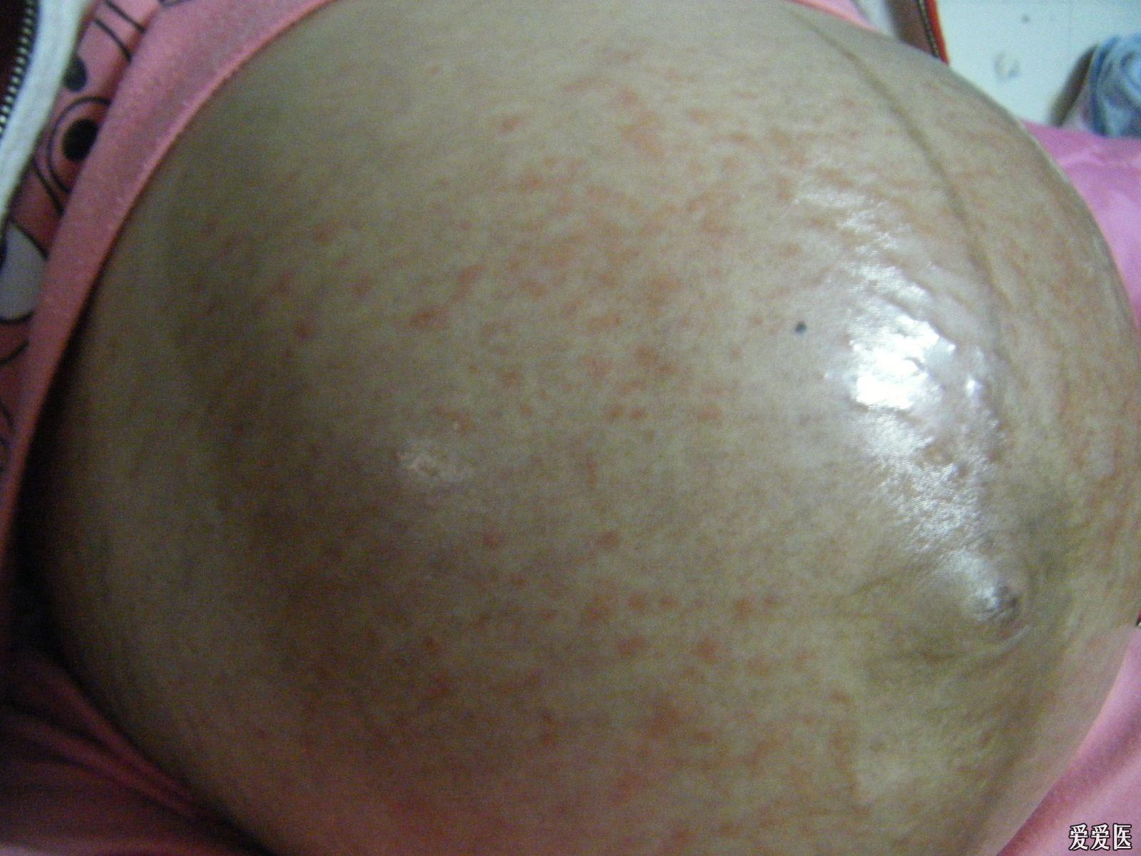 在线等待,一个孕妇的肚皮起的红色皮疹