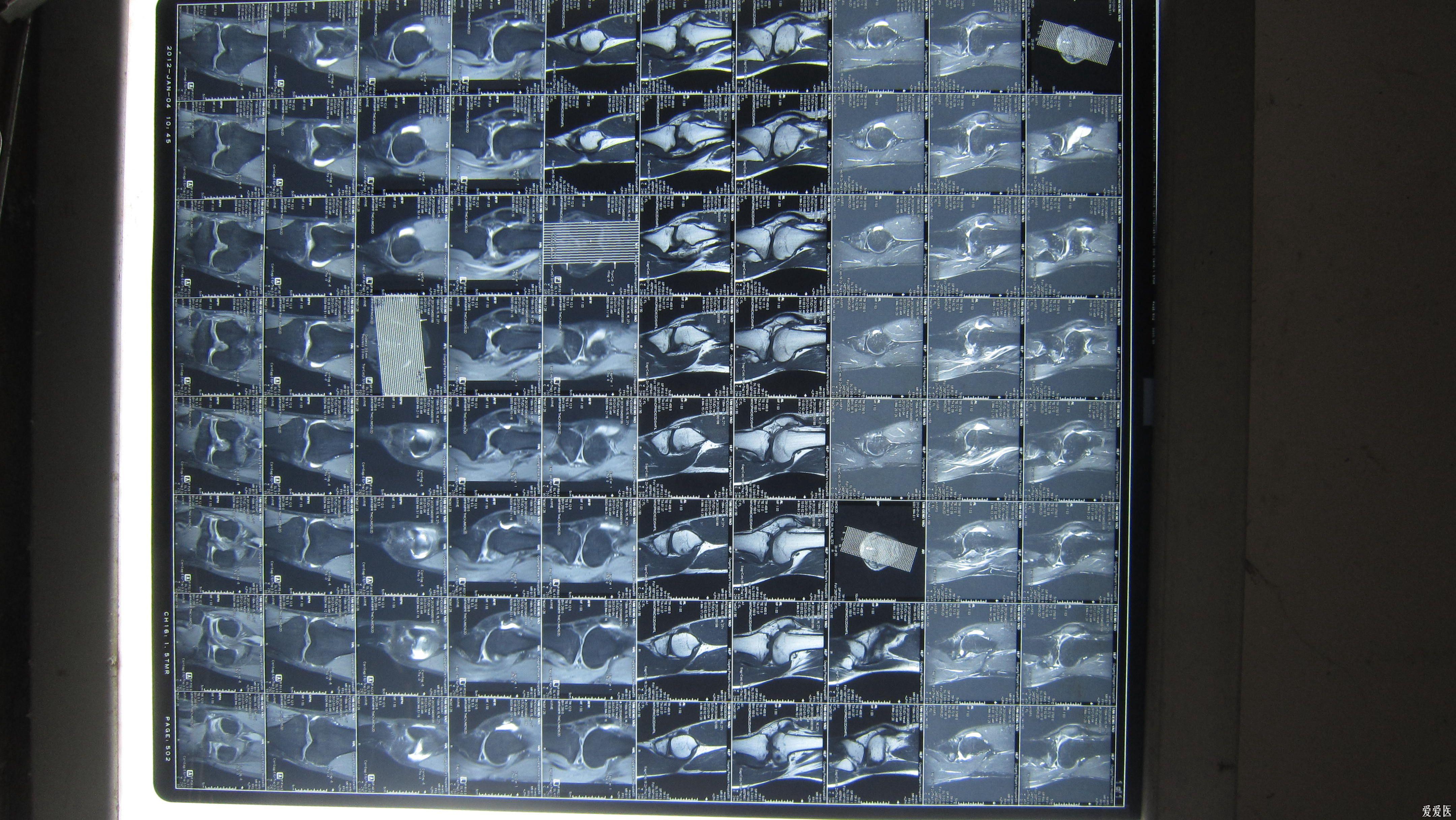 右膝关节挫伤紧急求助