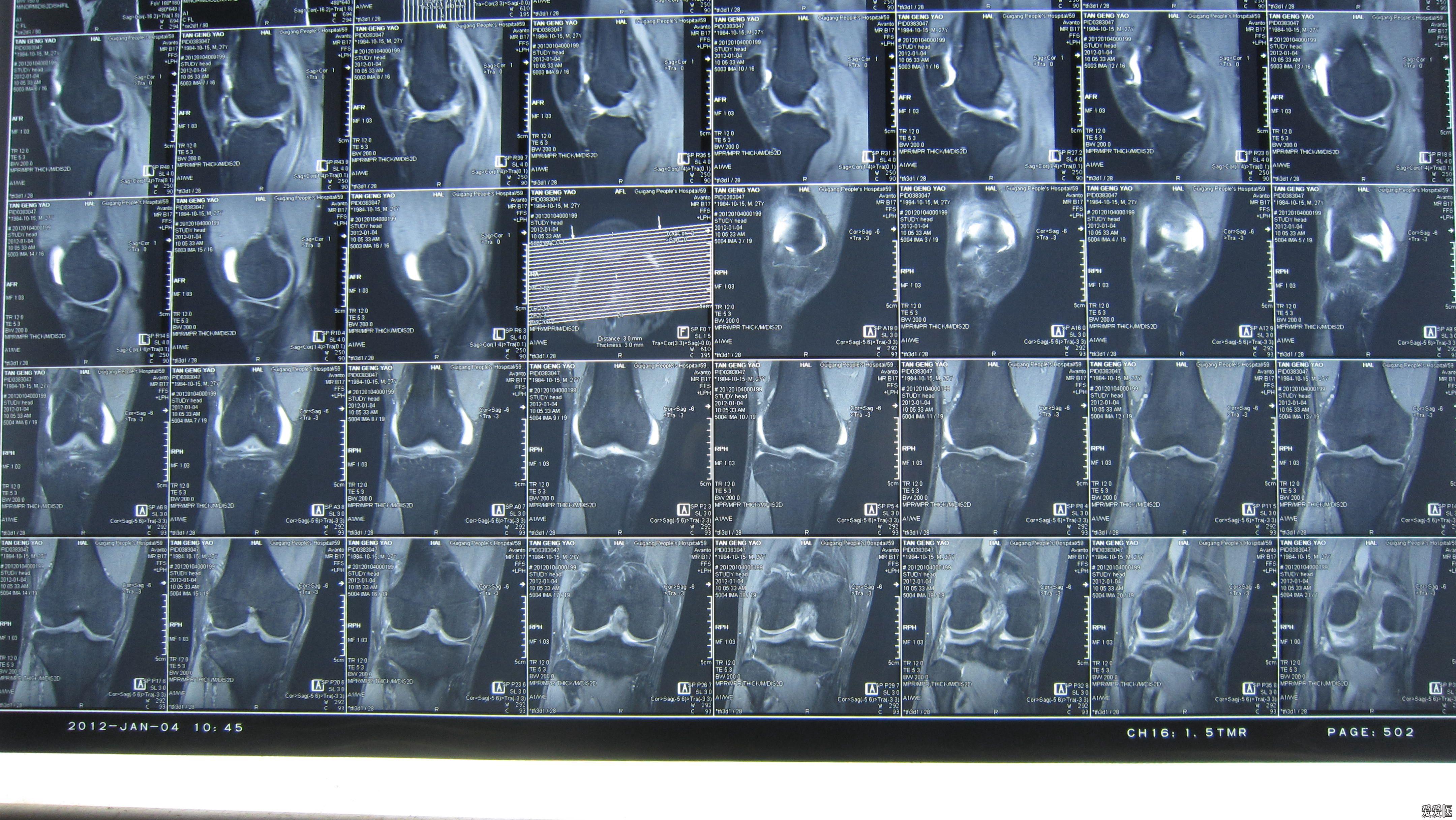 右膝关节挫伤紧急求助