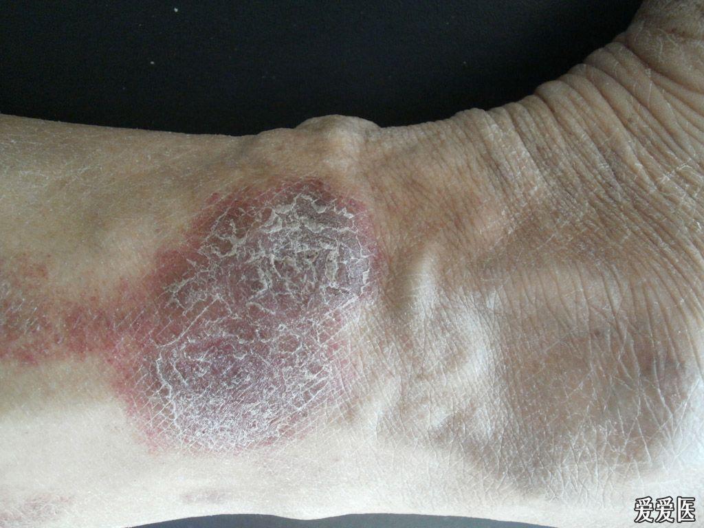 皮肤钙沉积症图片图片