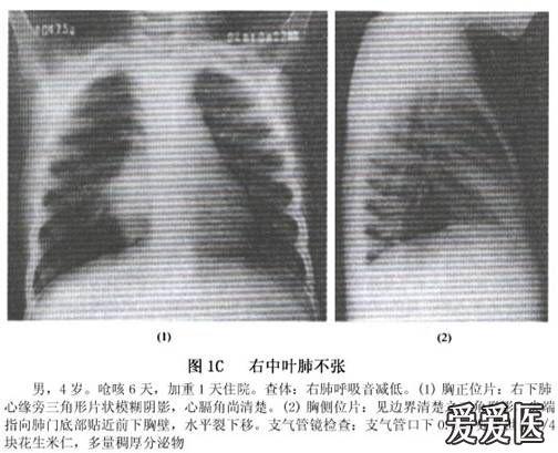右肺中叶综合征