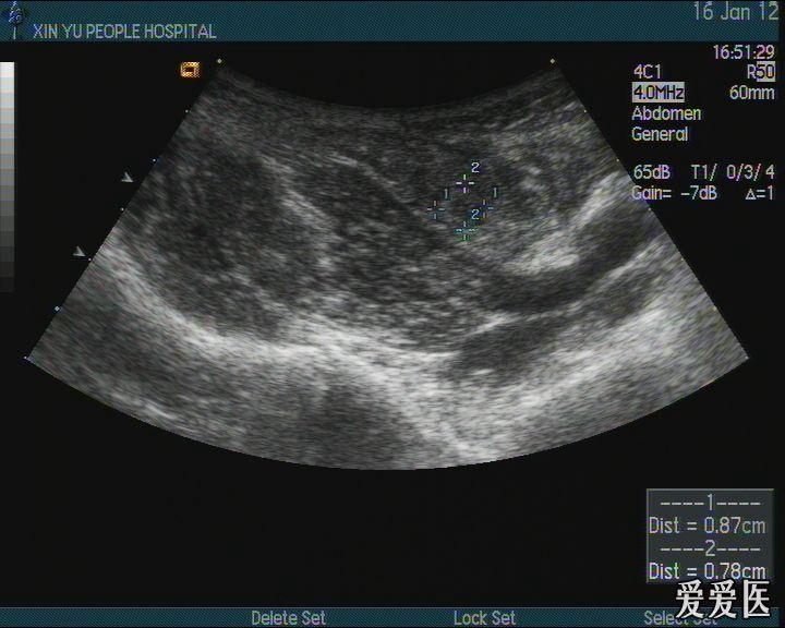 急性阑尾炎一般多久能好 12011623510769ebfe30af79ff.jpg