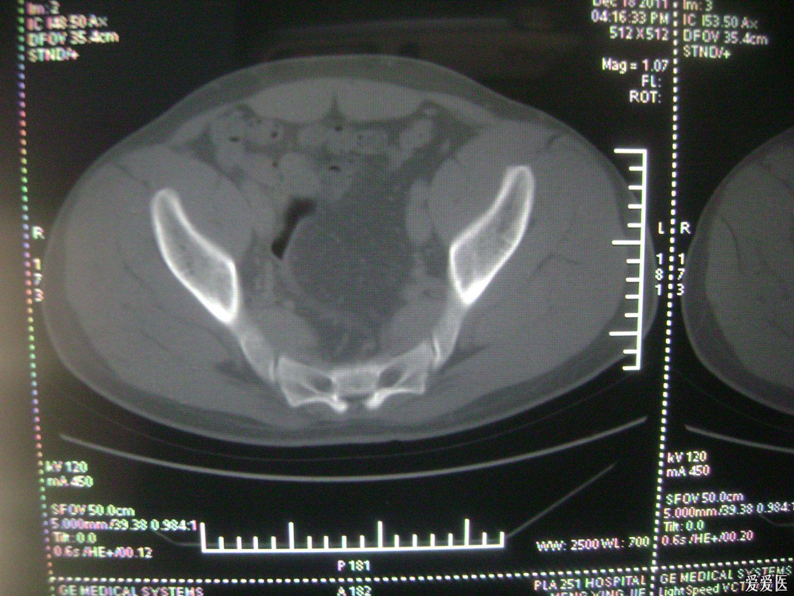 請大家幫忙看一下本人髖關節ct