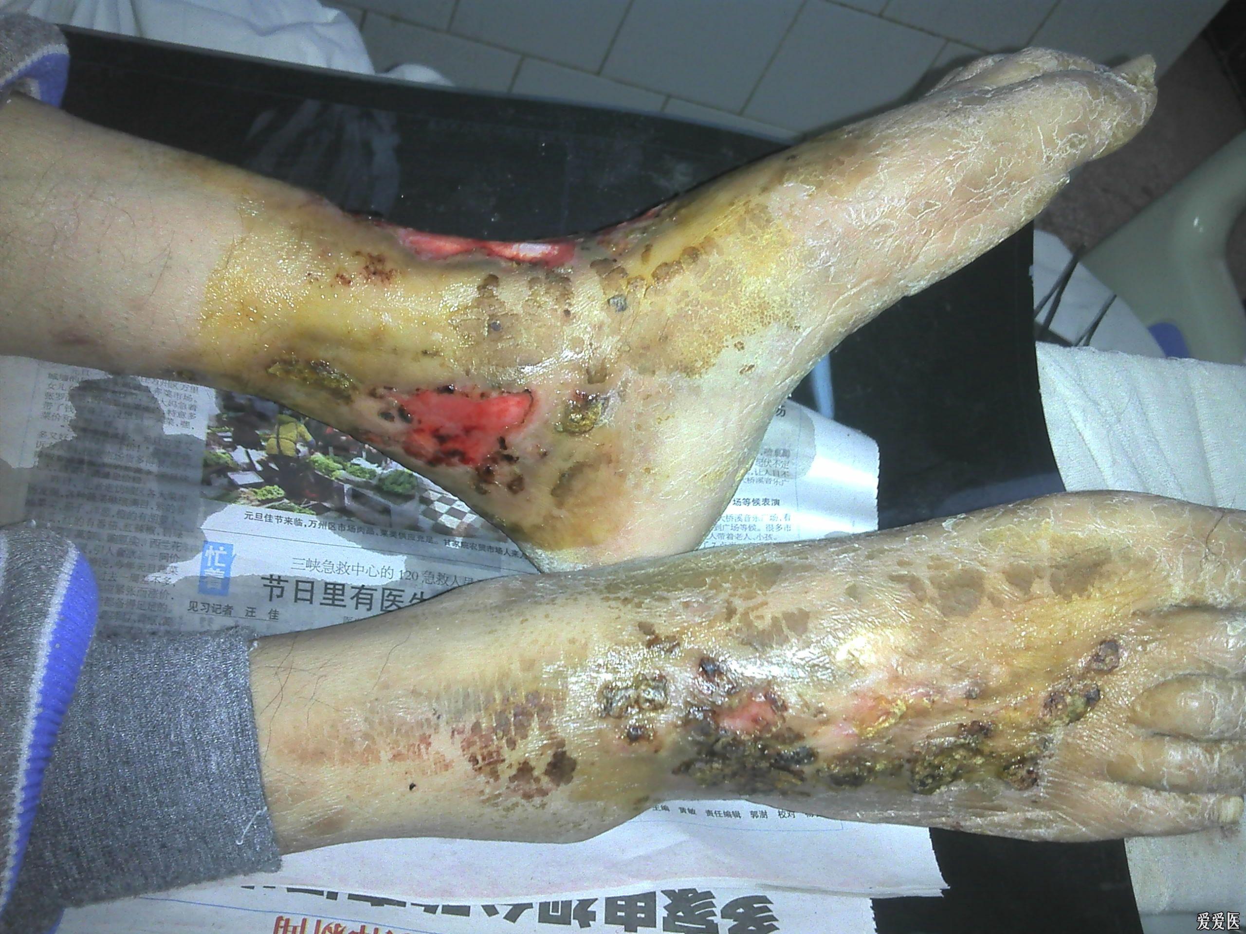下肢血管炎的症状图片图片