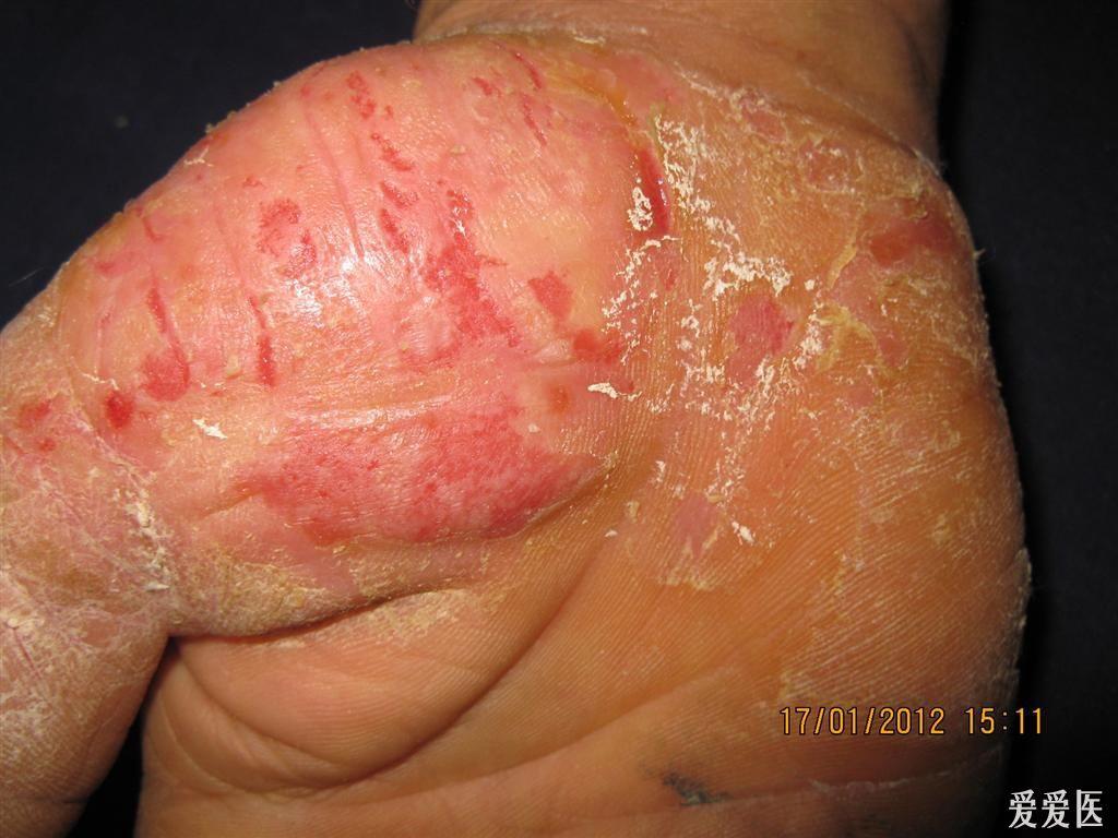 看图识病慢性湿疹