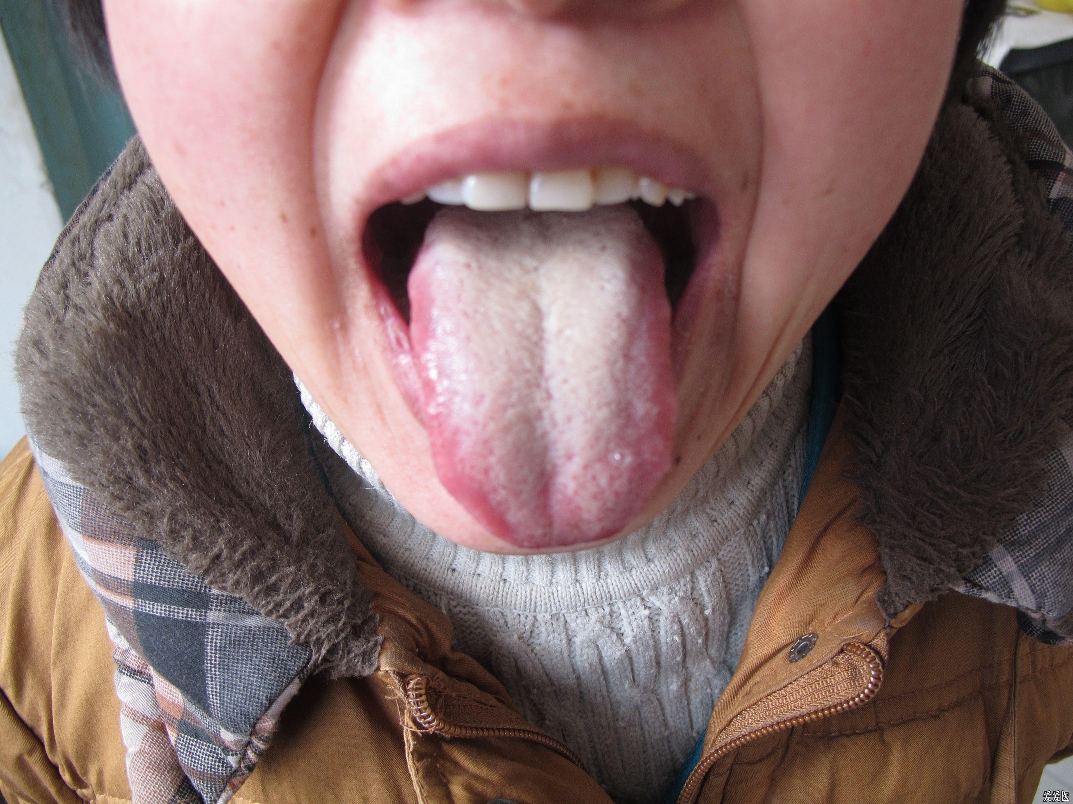 健康人的舌头图片侧面图片