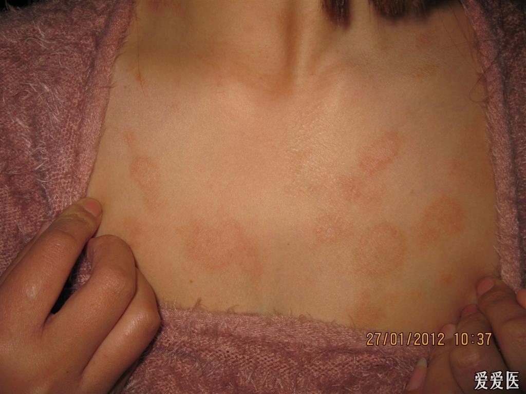 玫瑰糠疹,好大一个母斑 - 皮肤及性传播疾病讨论版 - 爱爱医医学论坛