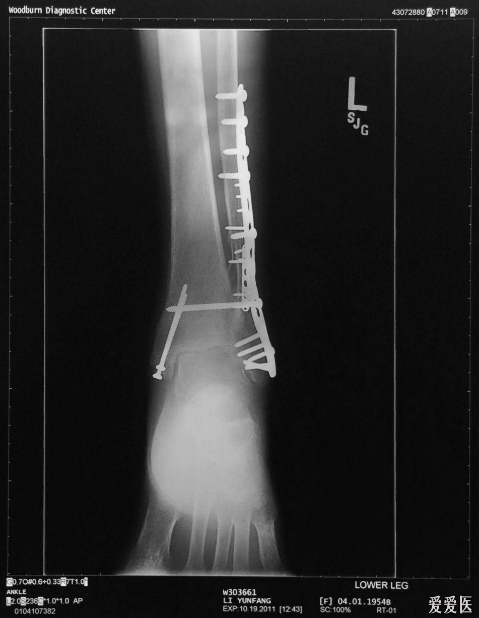 我朋友三踝骨折美國做的手術 大家給個意見參考?