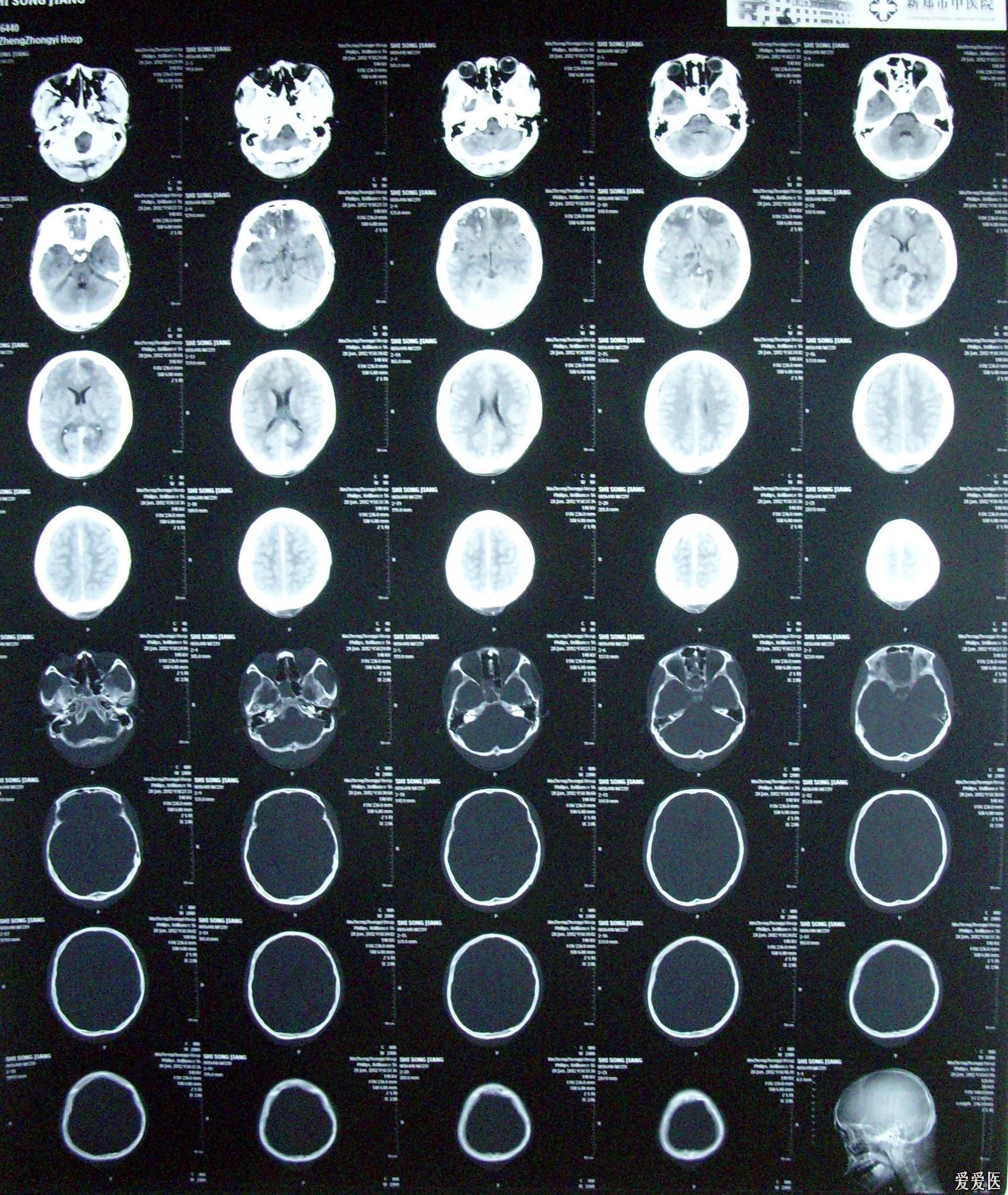 又一例特重型颅脑损伤脑干损伤
