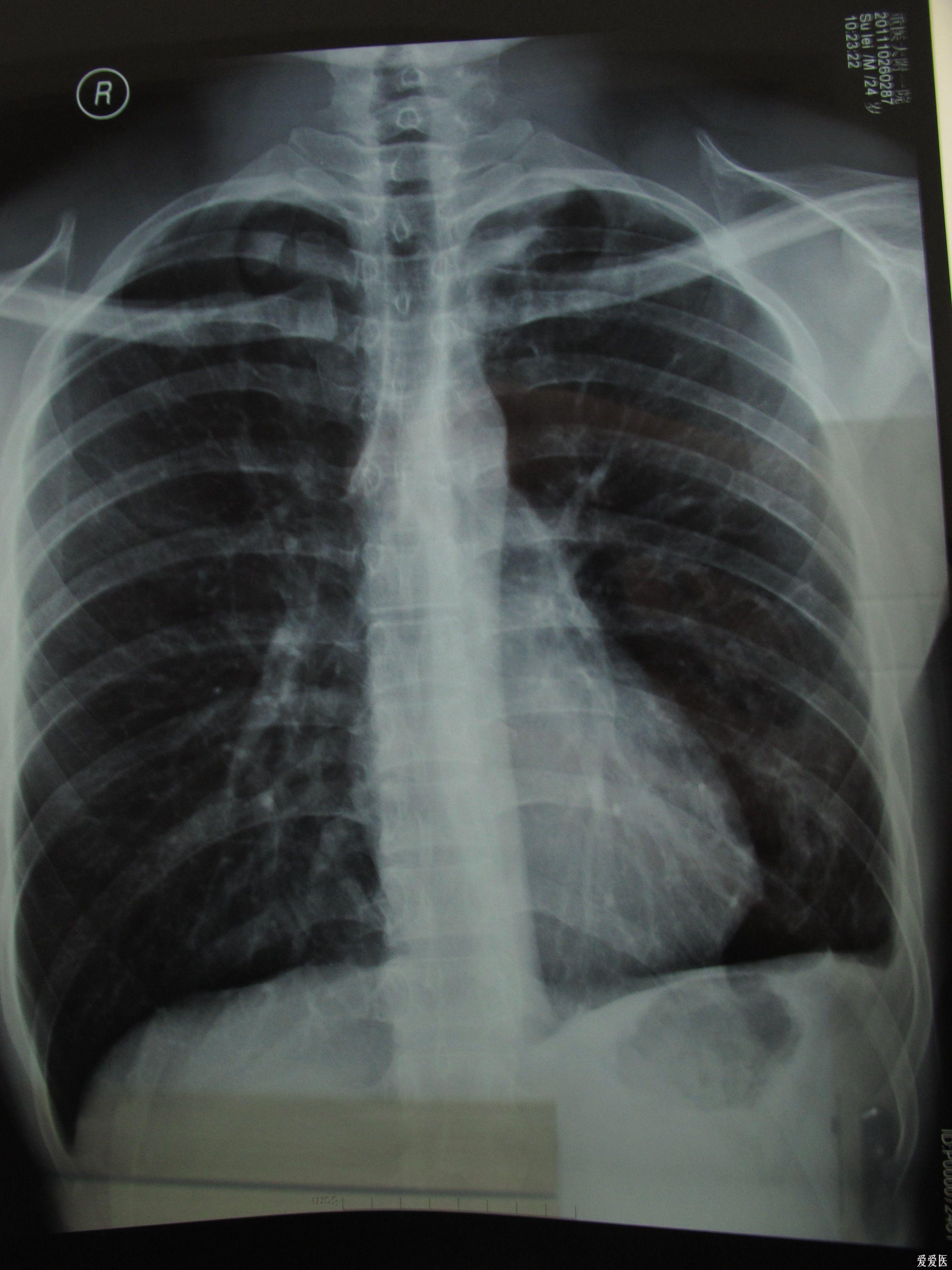 胸膜炎胸片图片