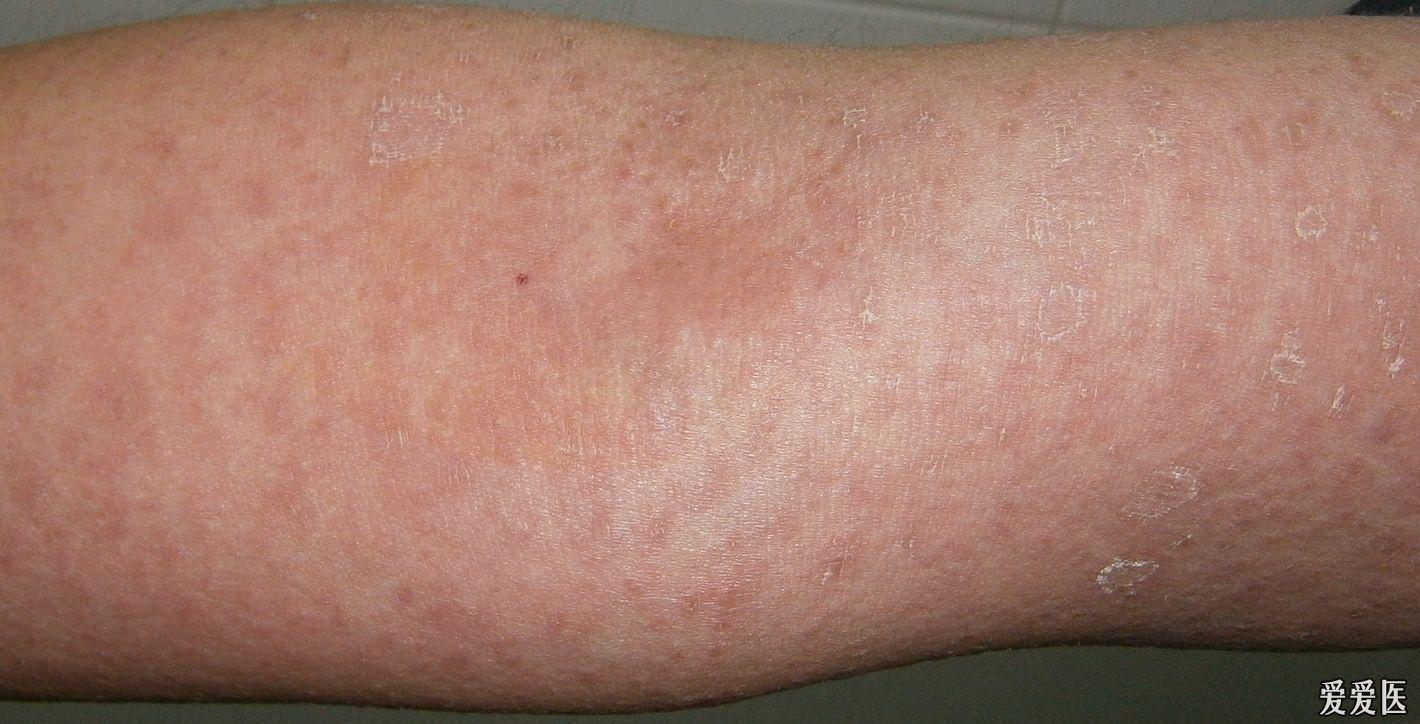 玫瑰糠疹