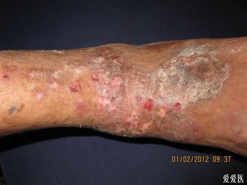 看图识病慢性湿疹