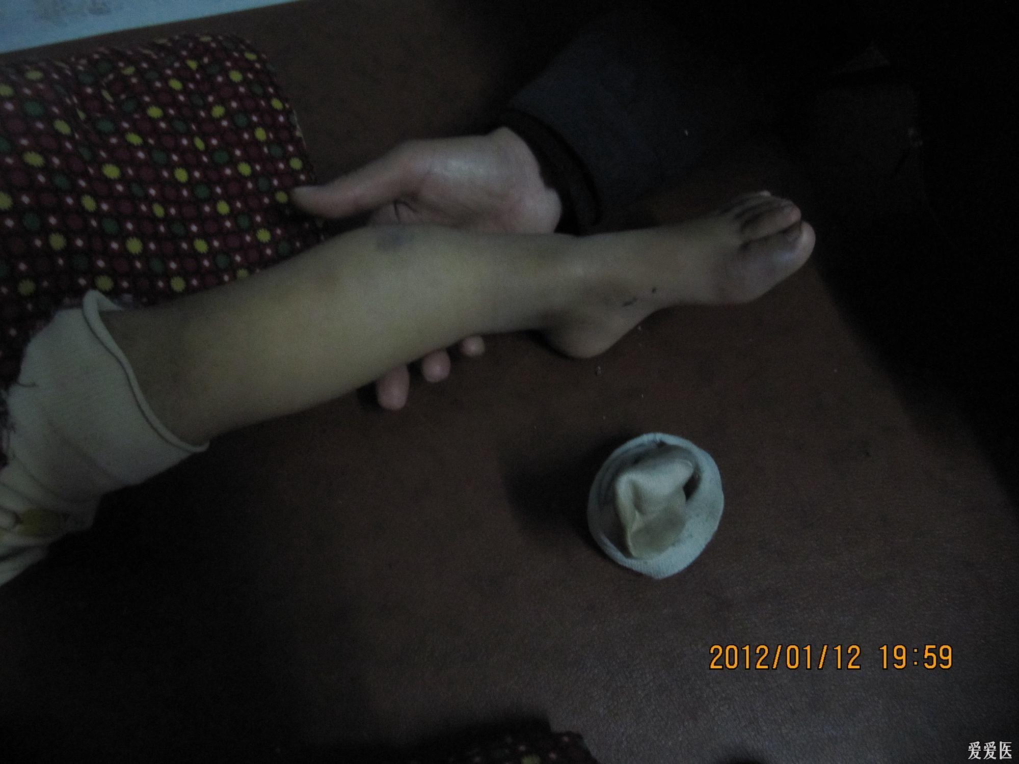 小儿左胫腓骨骨折 骨科与显微外科专业讨论版 爱爱医医学论坛