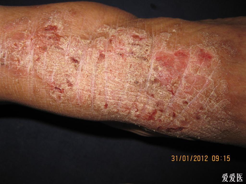 看图识病慢性湿疹