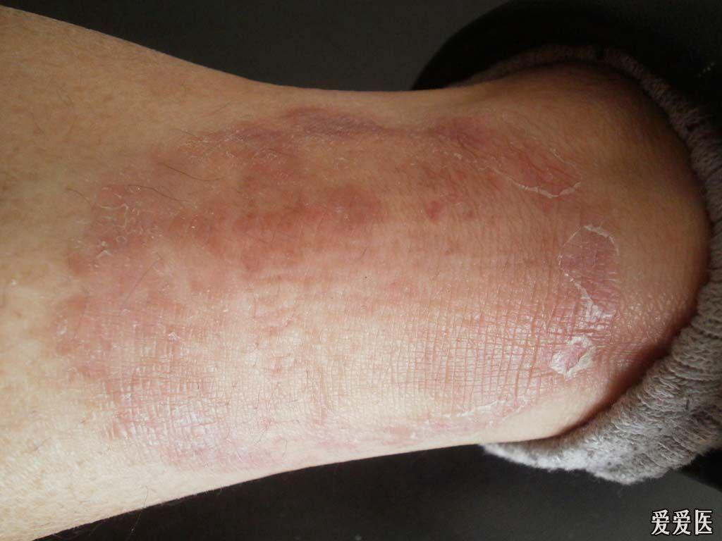 猜图病例1公布答案体癣真菌63人回答准确均加分