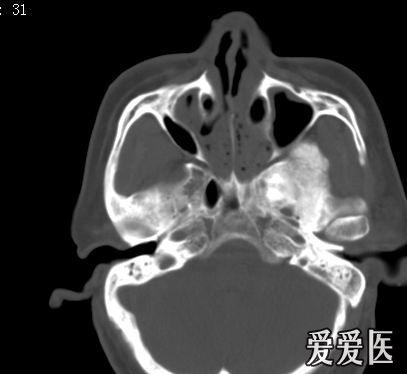 蝶骨大翼圆孔图片