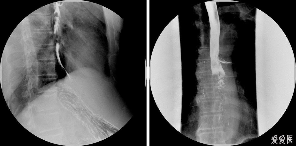 食管癌龛影图片图片