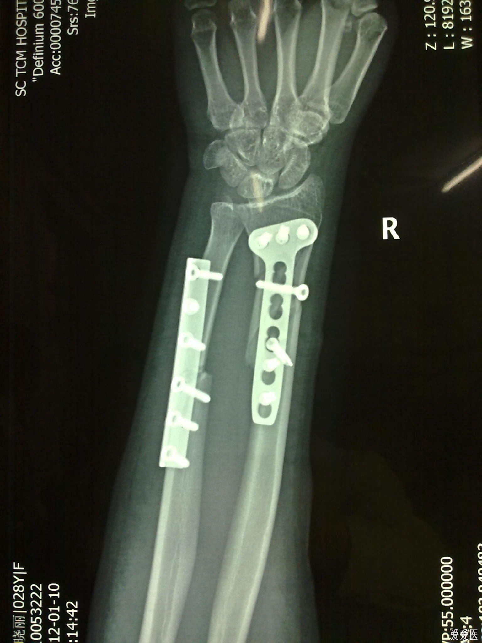 右手手腕桡骨骨折图片图片