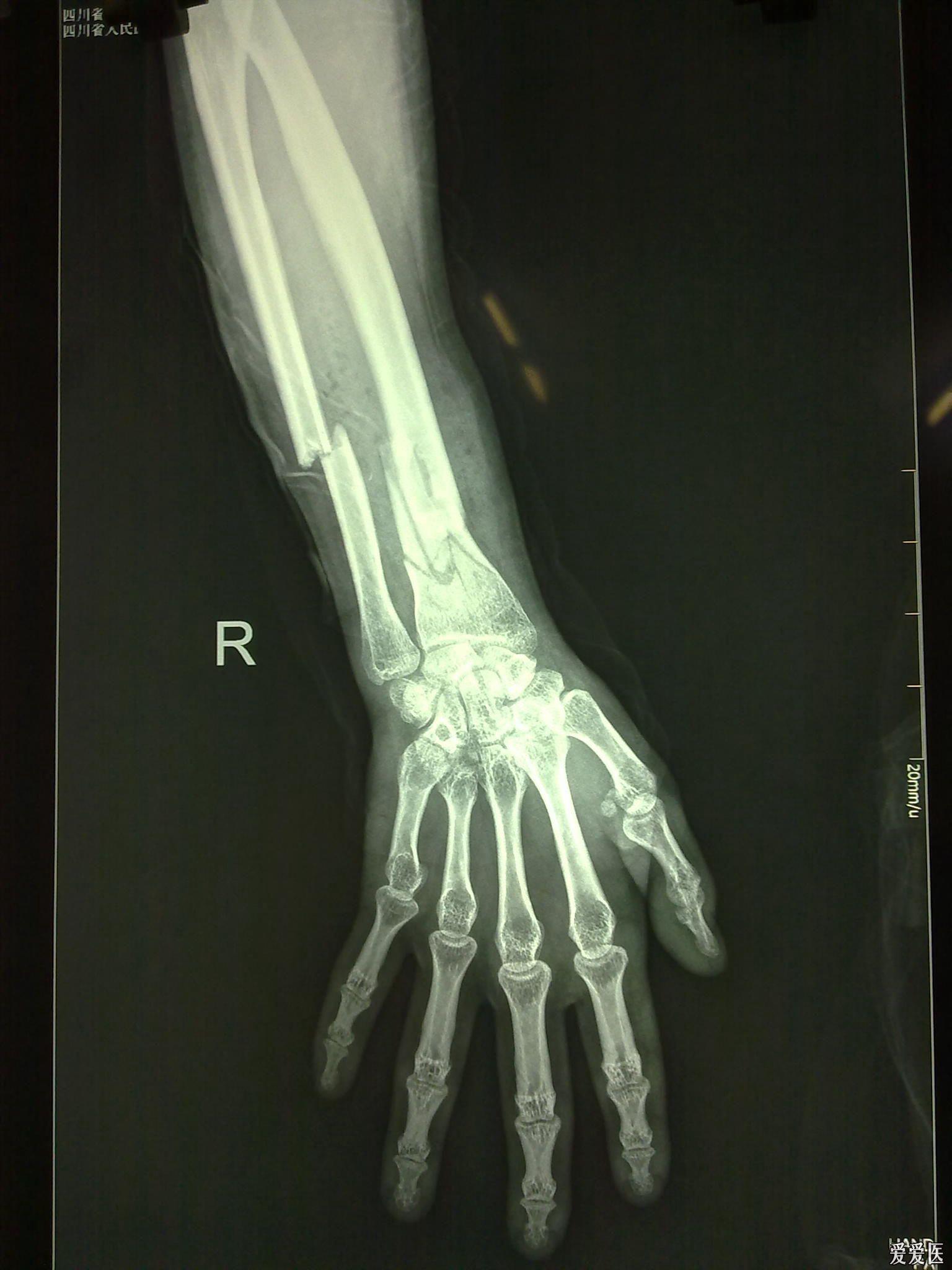 右手尺骨骨折图片图片