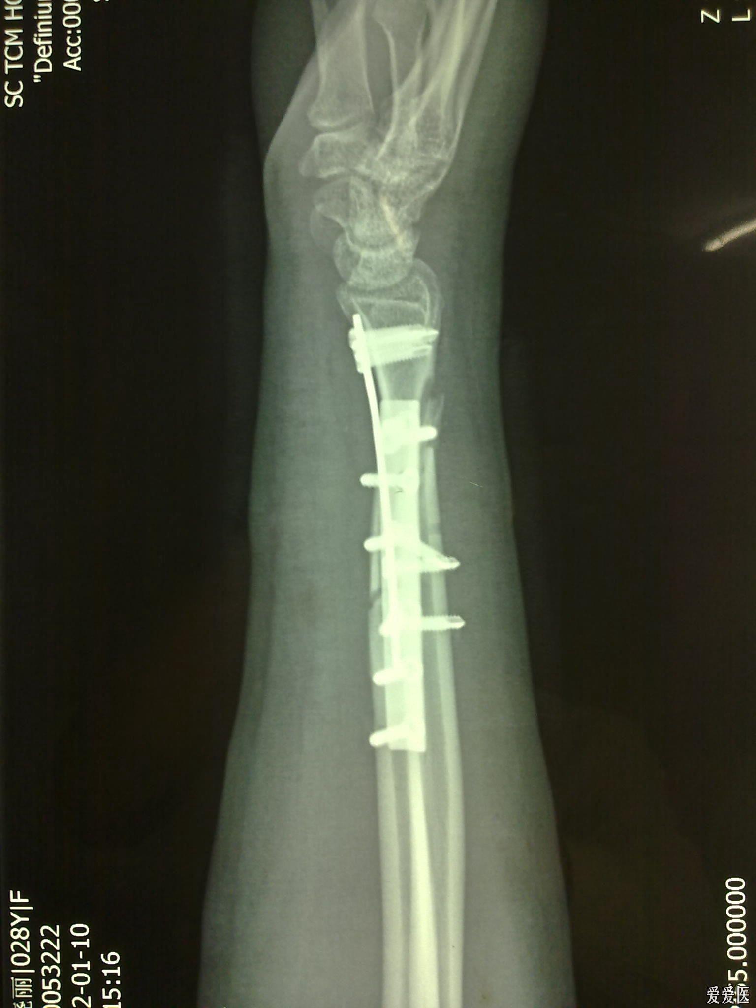 右桡骨远端骨折图片
