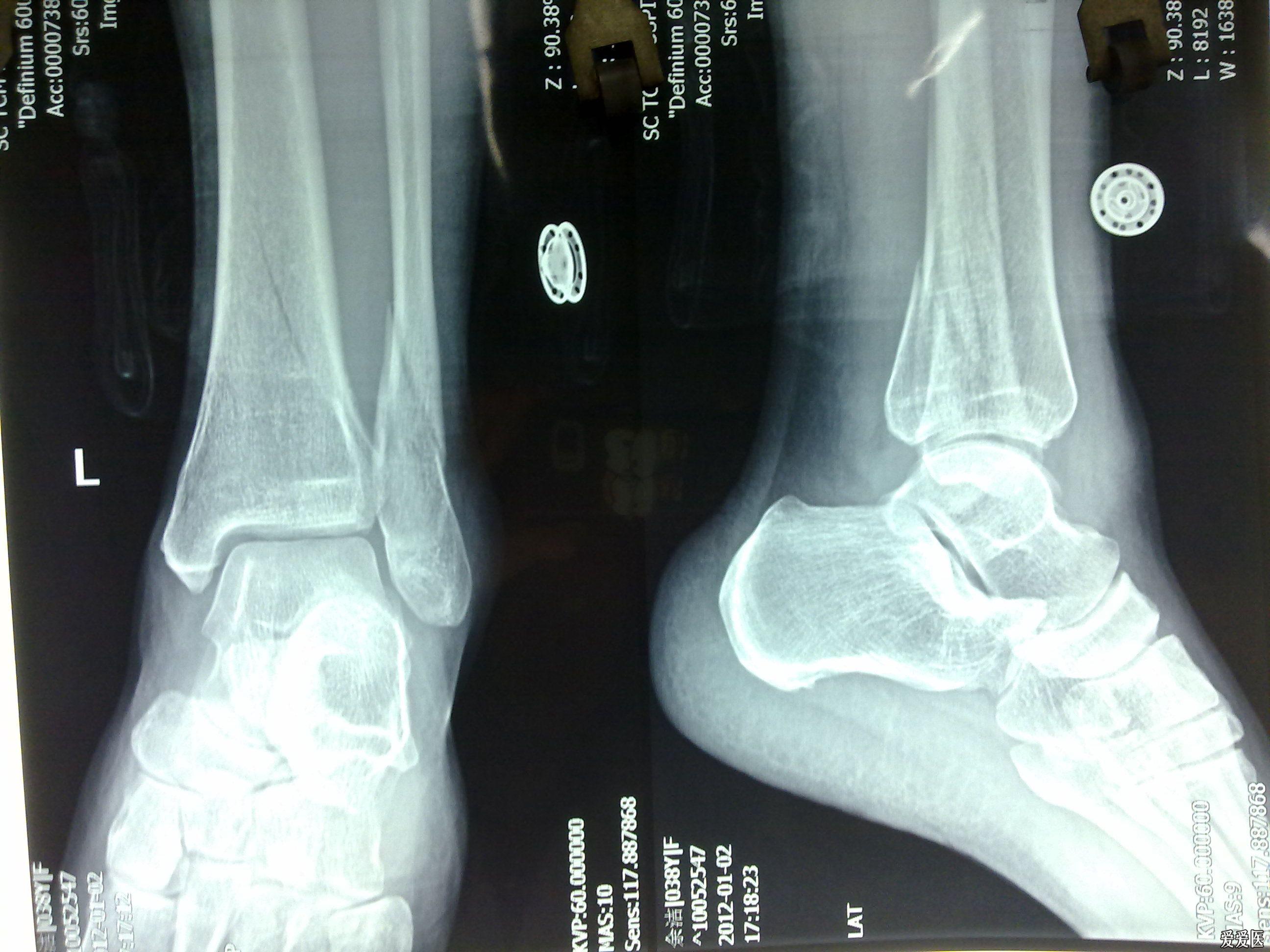 左脚脚踝骨折图片