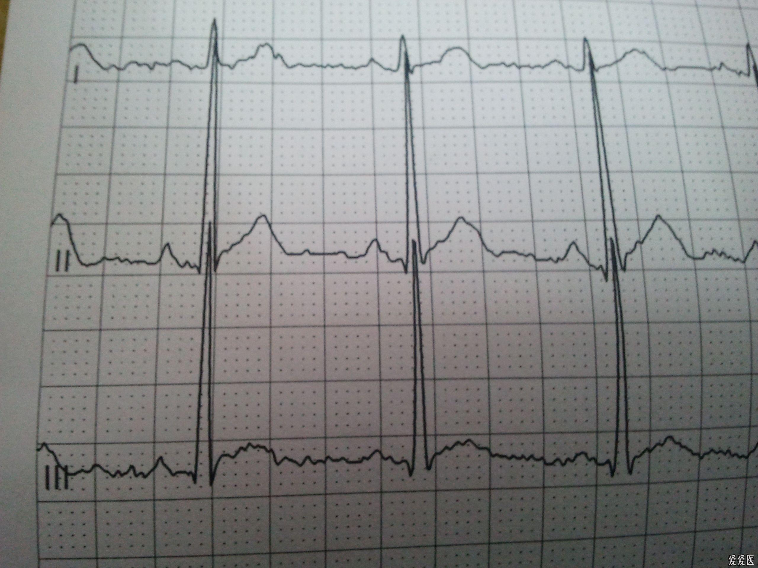 20岁青年运动后感觉难受做心电图提示心肌缺血
