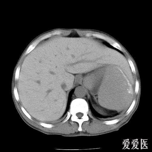 肝尾状叶CT图片