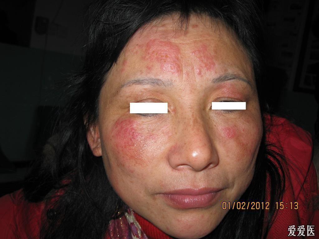 大人脸部湿疹症状图片图片