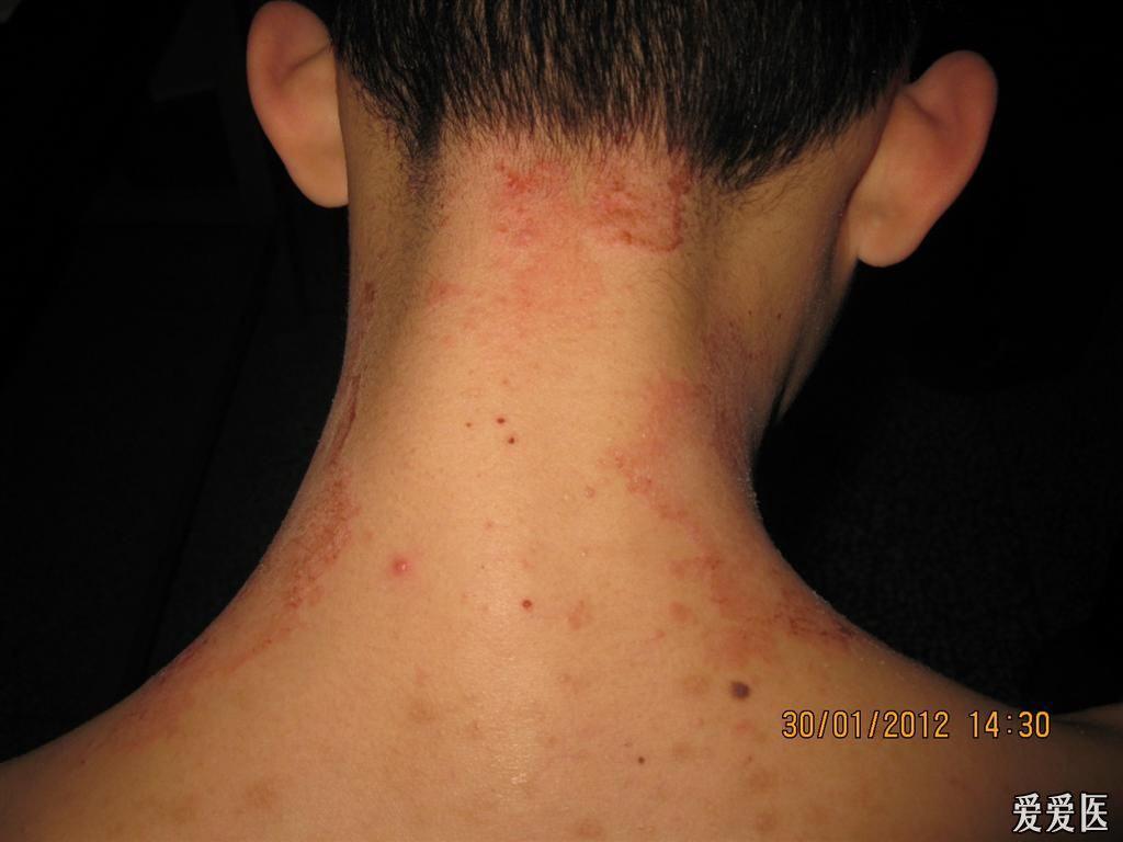荨麻疹环形红斑图片图片
