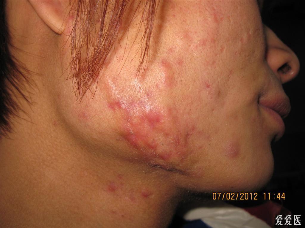 痤疮所致的瘢痕疙瘩