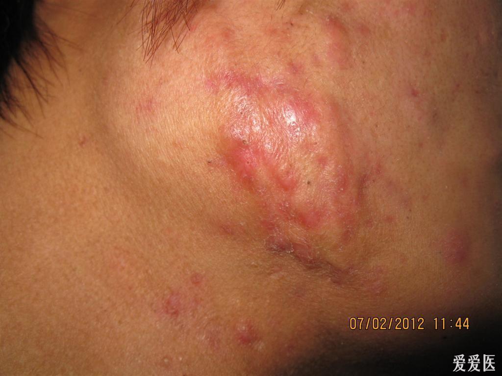 痤疮所致的瘢痕疙瘩