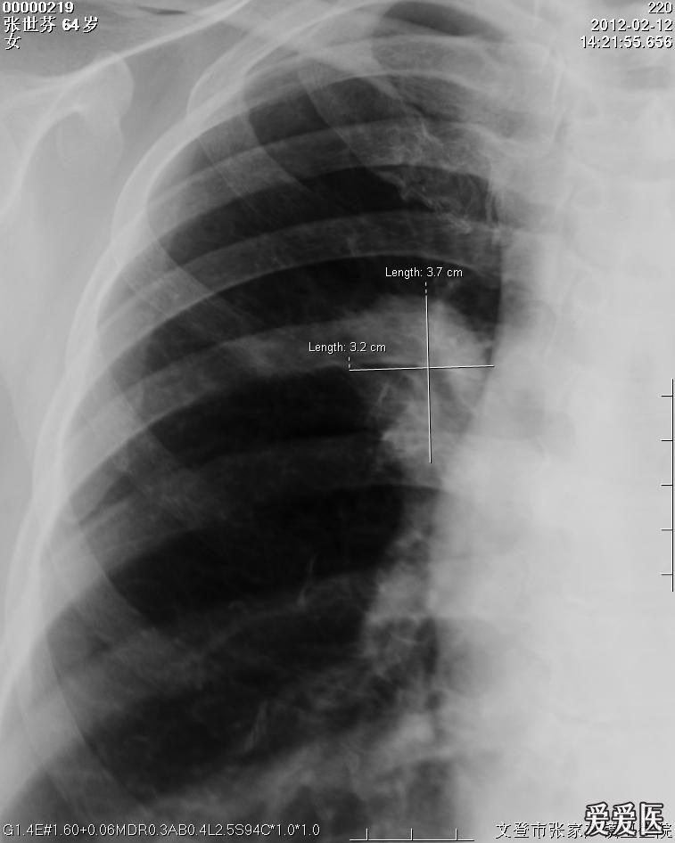 肺门x线图片图片