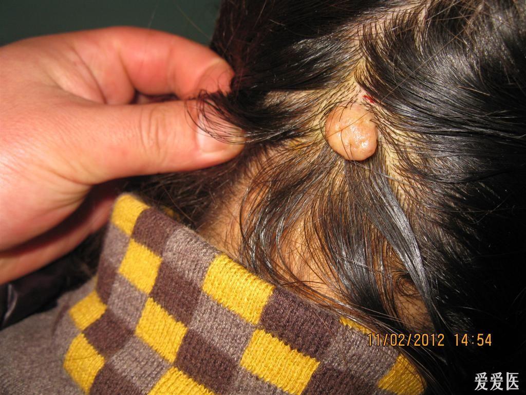 看图识病软纤维瘤已手术切除