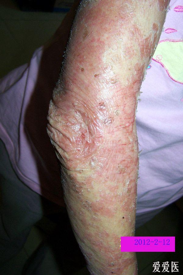 一个严重的皮肤病慢性湿疹