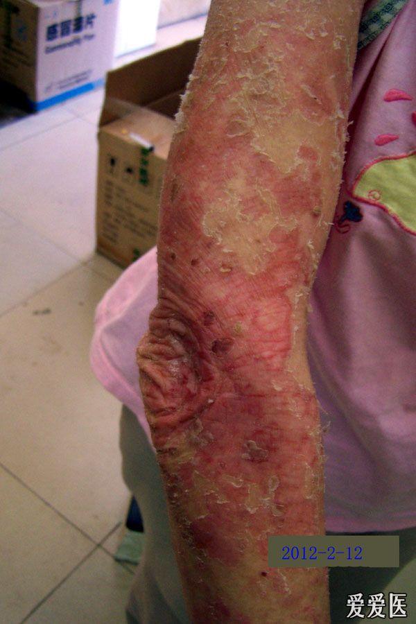一个严重的皮肤病慢性湿疹