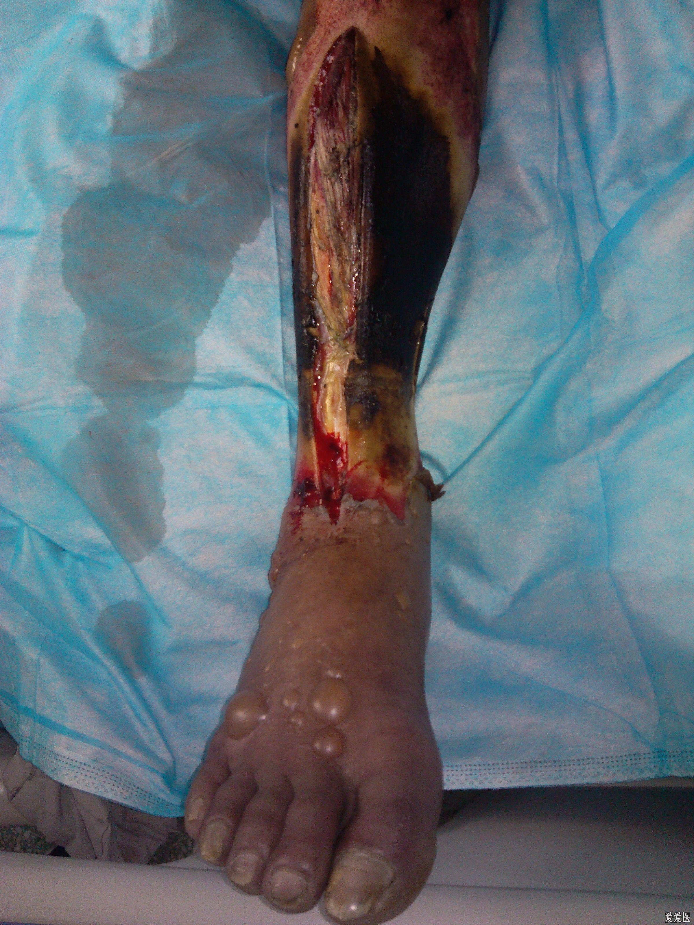 发表一个烧伤新病例请大家指教