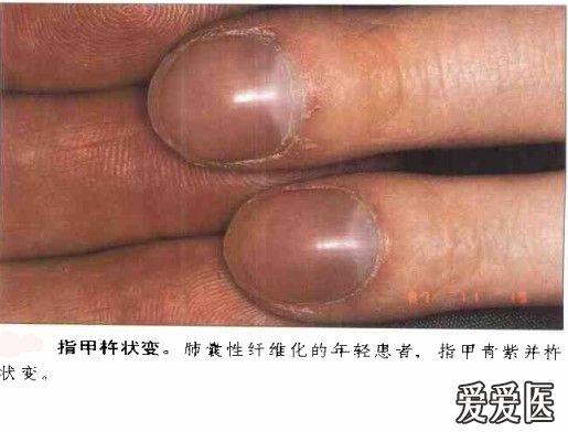 【看图识病】(1)杵状指