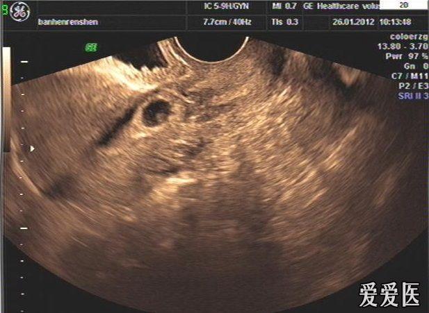 疤痕妊娠的超声图片图片