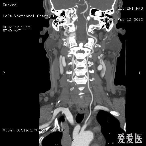 颈脑部cta欣赏一例椎动脉变异