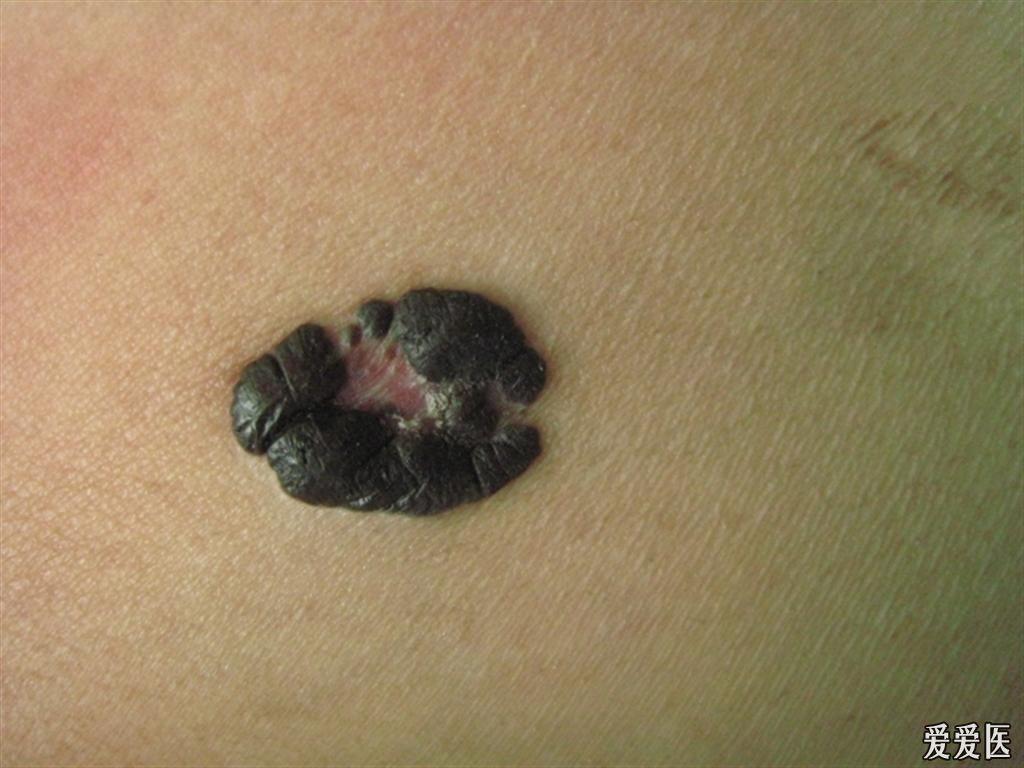 结节性黑色素瘤外观图片