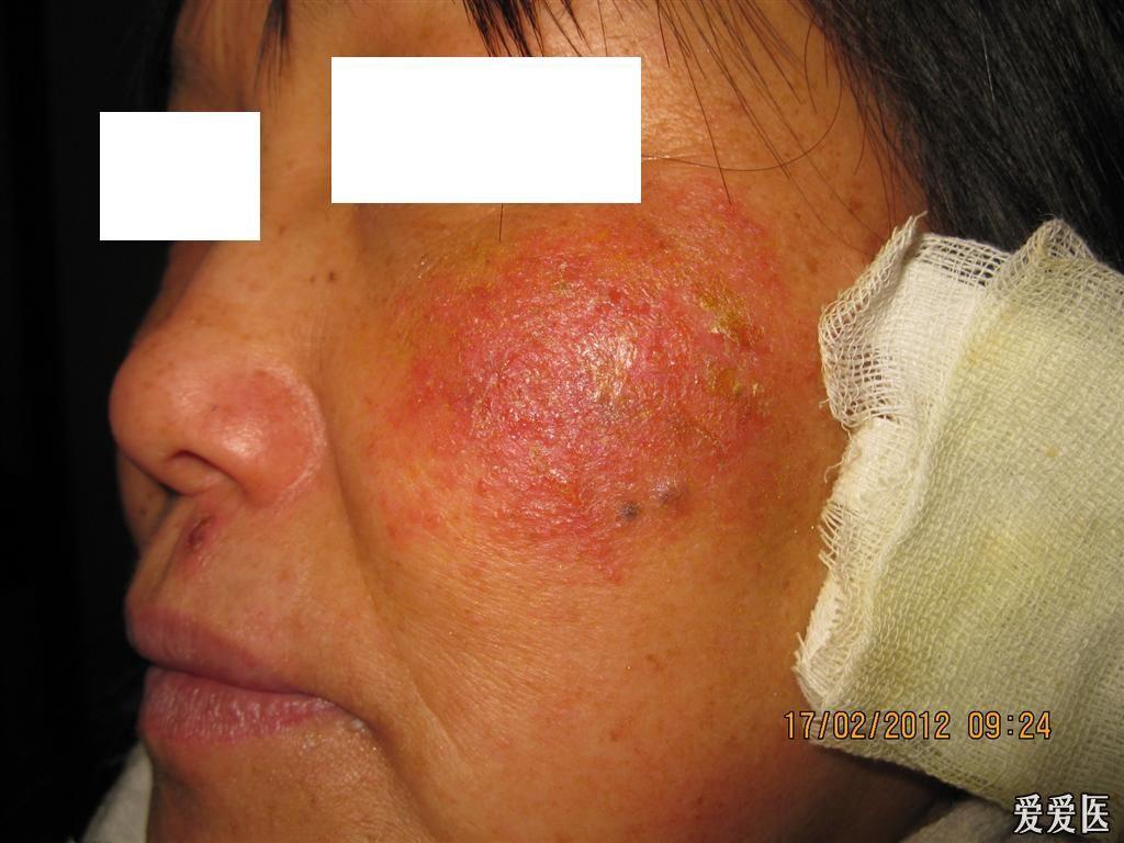 患者:女,49岁,左面部红斑渗出,轻度瘙痒1天