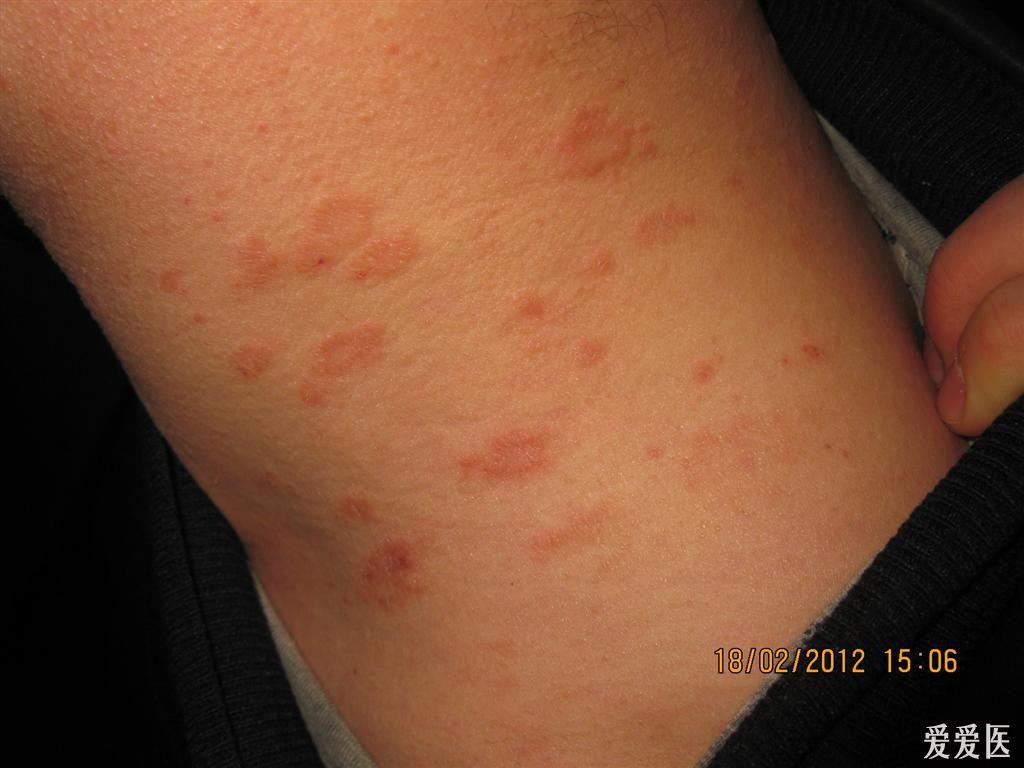 玫瑰糠疹怎么引起的疹图片