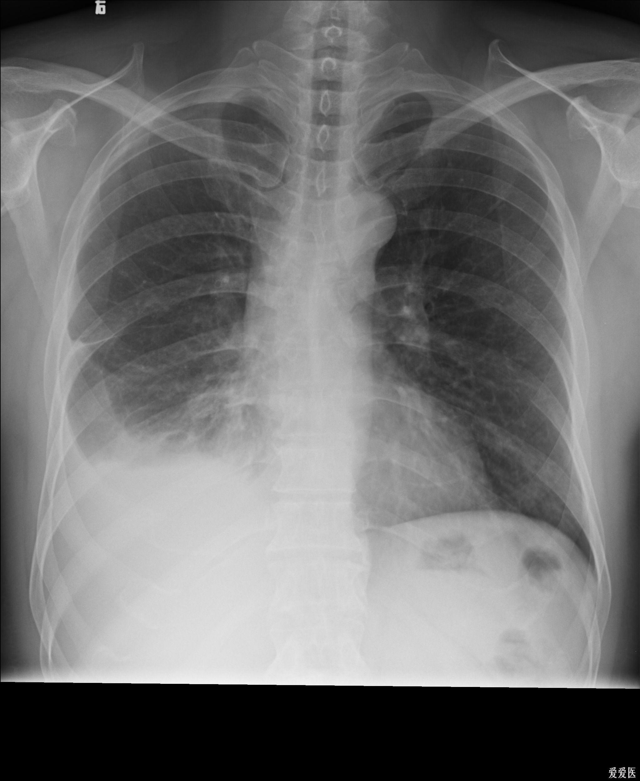 胸片:肺大疱 or 局限性肺气肿?
