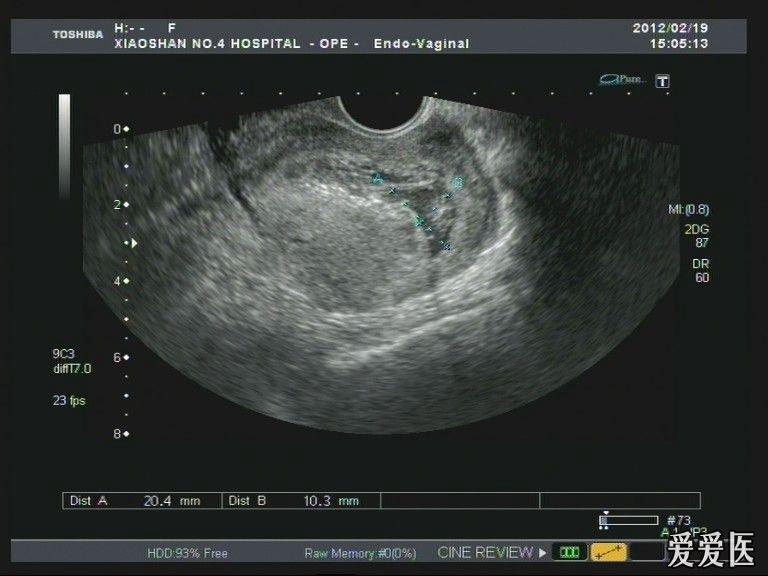 疤痕妊娠適合哪種流產