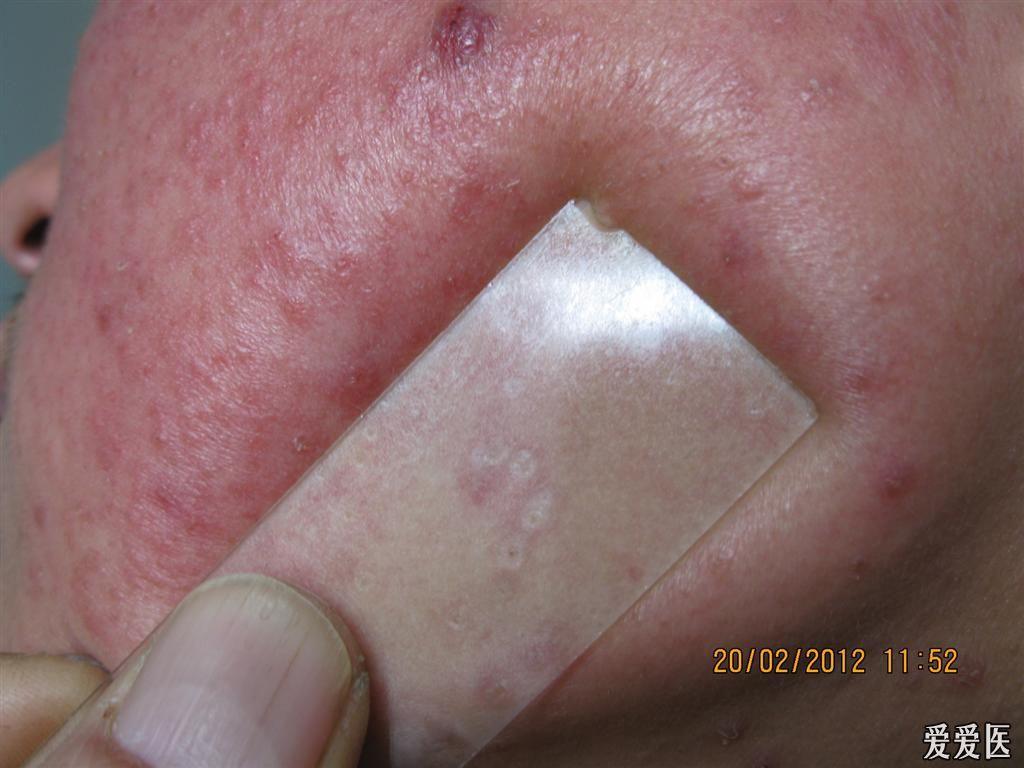 看图识病颜面播散性粟粒性狼疮